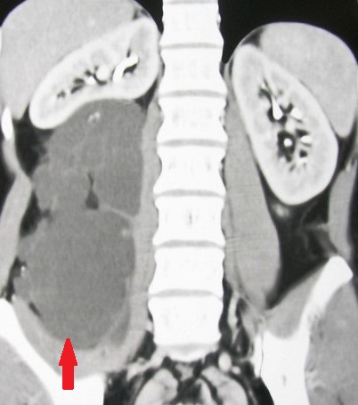 RETROPERITONEAL MUCINOUS CYSTADENOMA 