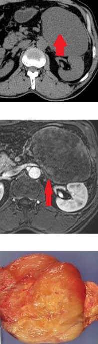 RETROPERITONEAL MYXOID LIPOSARCOMA