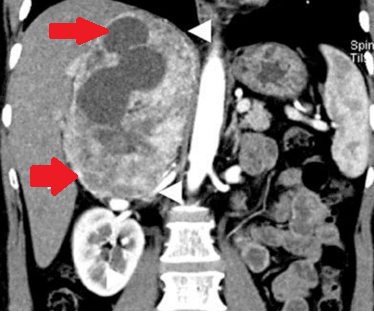 RETROPERITONEAL PARAGANGLIOMA 