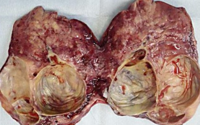 RETROPERITONEAL PARAGANGLIOMA 