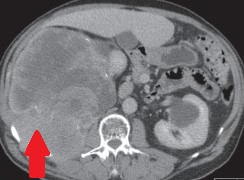 RETROPERITONEAL SARCOMA