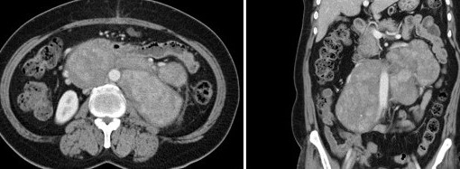 RETROPERITONEAL SMOOTH MUSCLE TUMOR