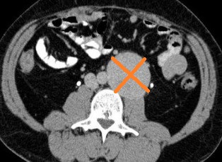 RETROPERITONEAL STROMAL TUMOR 