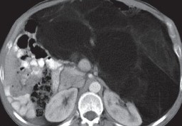 RETROPERITONEAL WELL DIFFERENTIATED LIPOSARCOMA