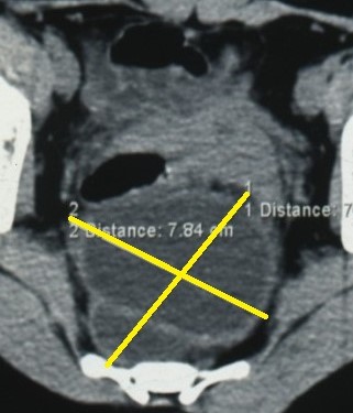 RETRORECTAL EPIDERMOID CYST 
