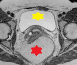 RETRORECTAL TUMOR 