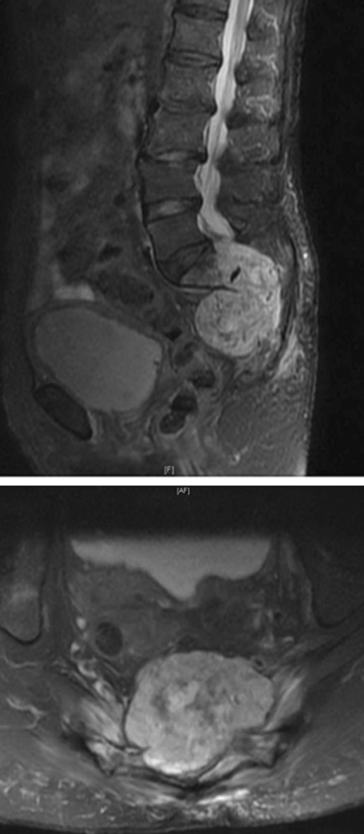 SACRAL CHORDOMA 