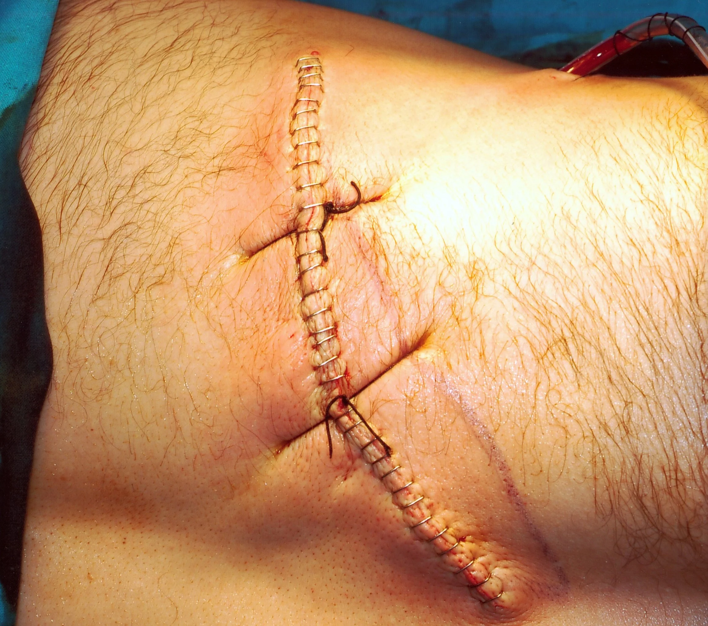 CHEST WALL SARCOMA