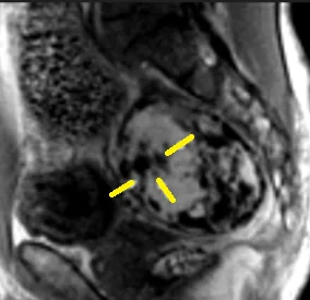 PELVIC CHONDROLIPOMA