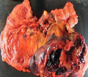LIPOSARCOMA ASCENDING COLON