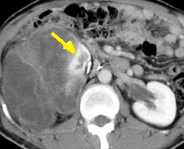 MYXOID LIPOSARCOMA