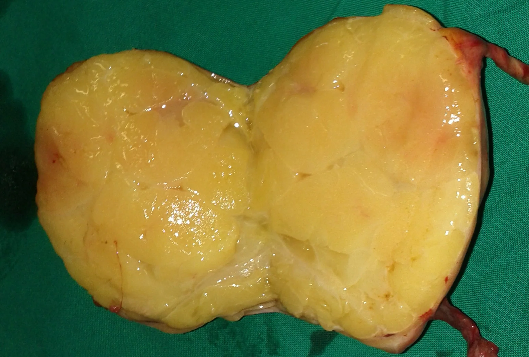 LIPOSARCOMA