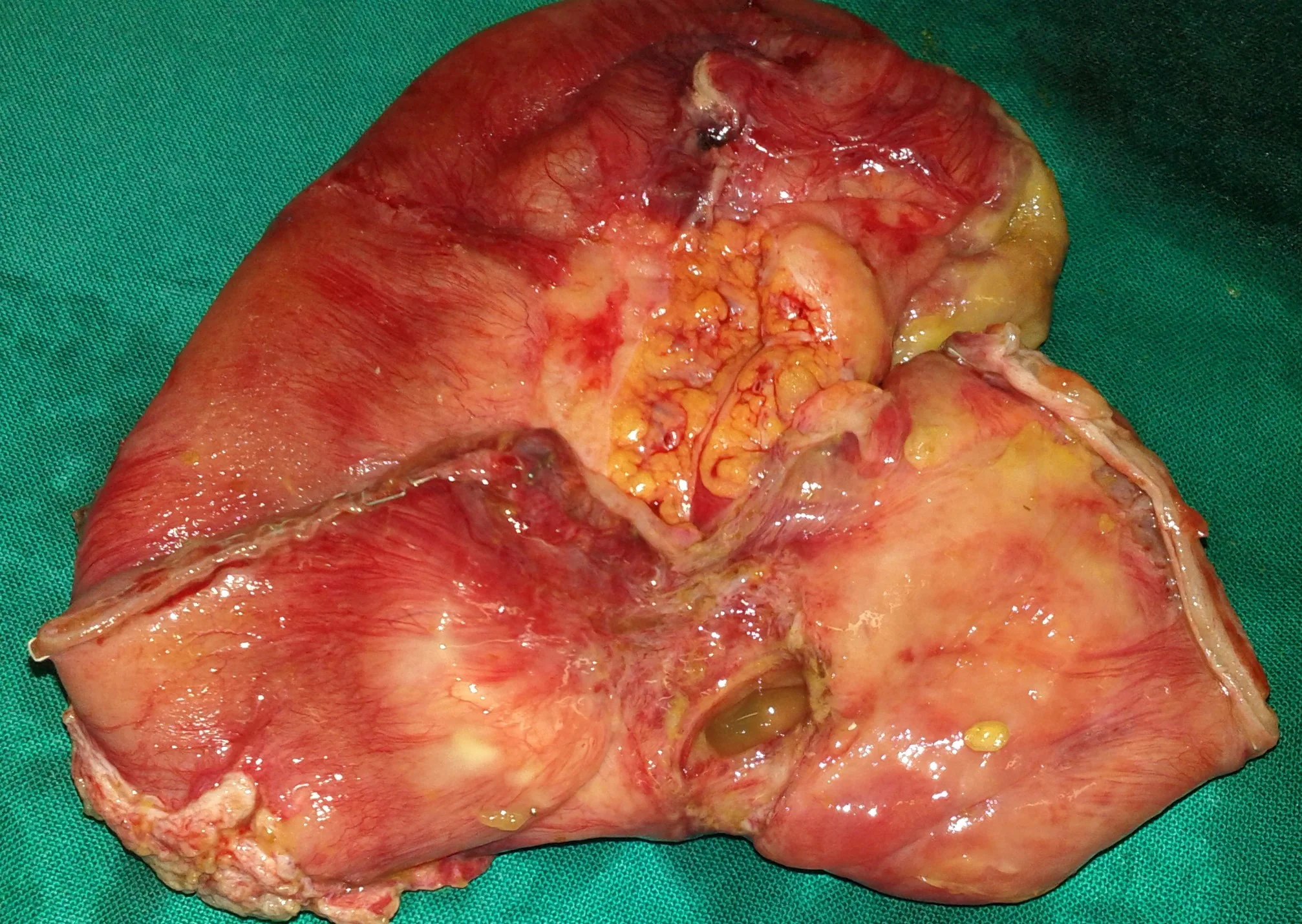LIPOSARCOMA
