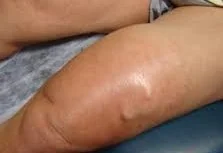 LIMB CHONDROSARCOMA
