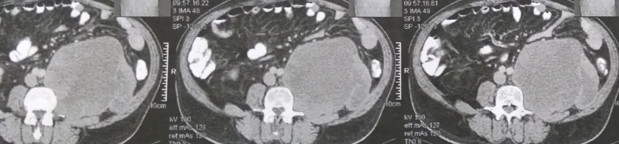 ANGIOSARCOMA