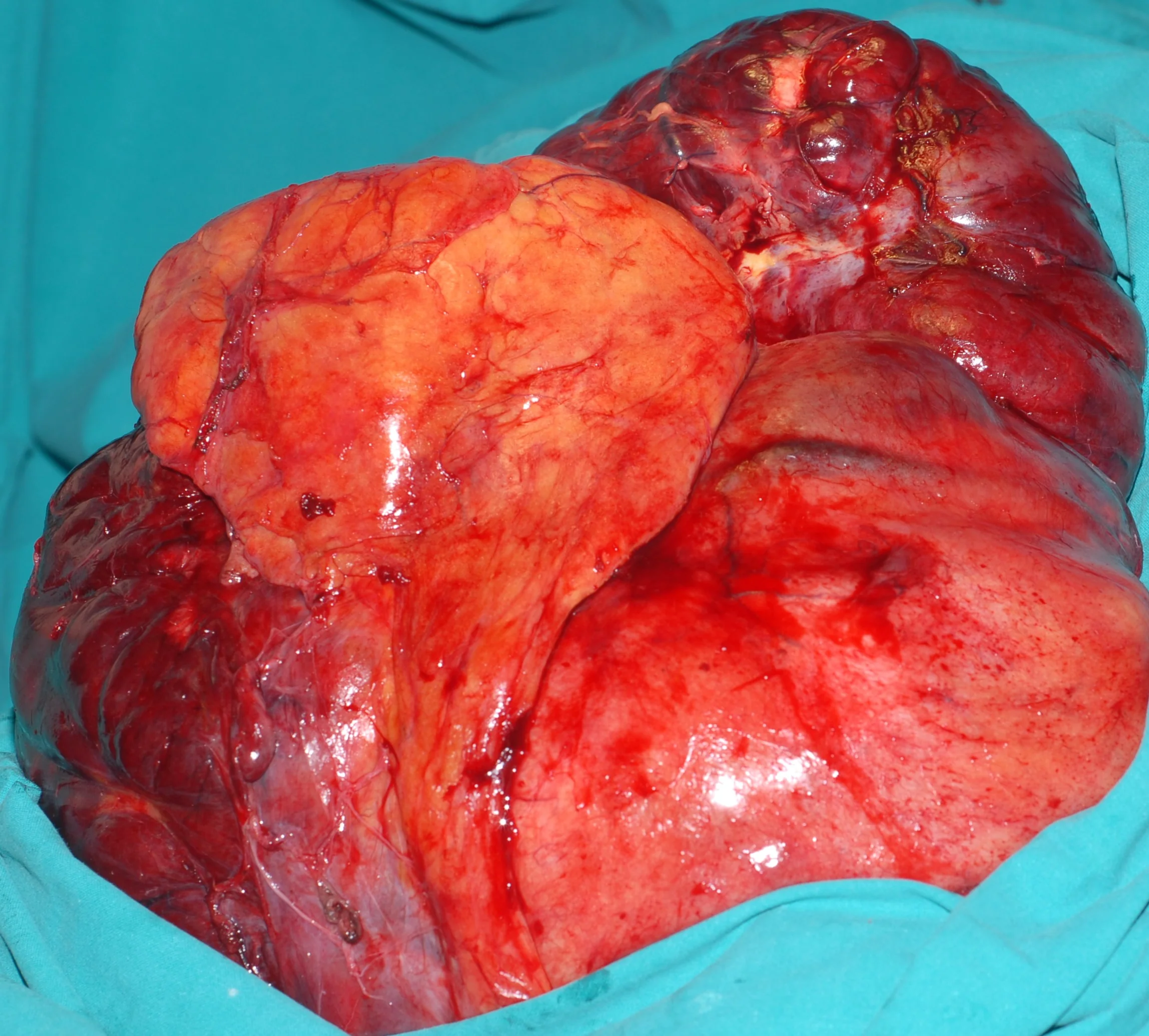 ABDOMINAL SARCOMA