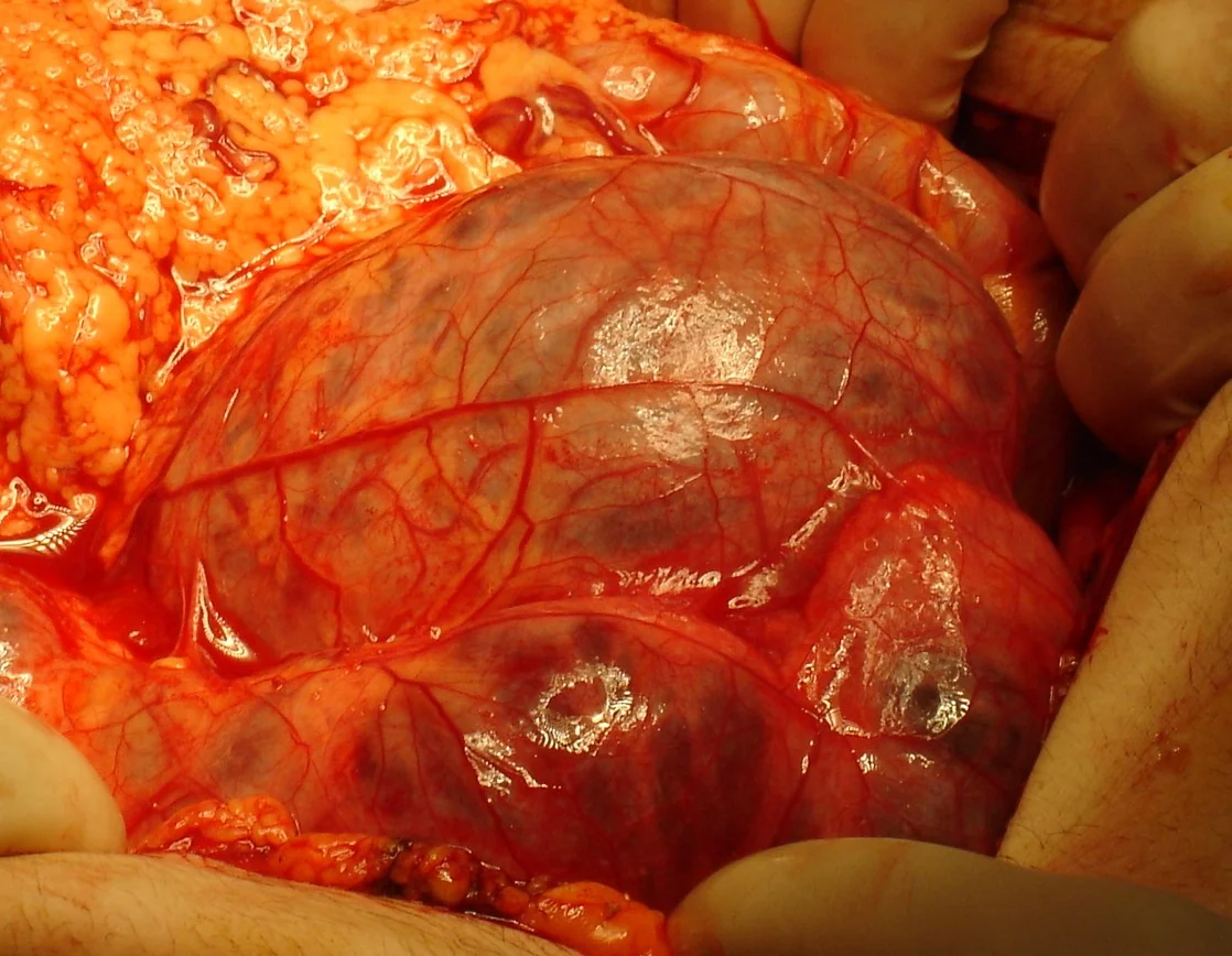 ABDOMINAL SARCOMA