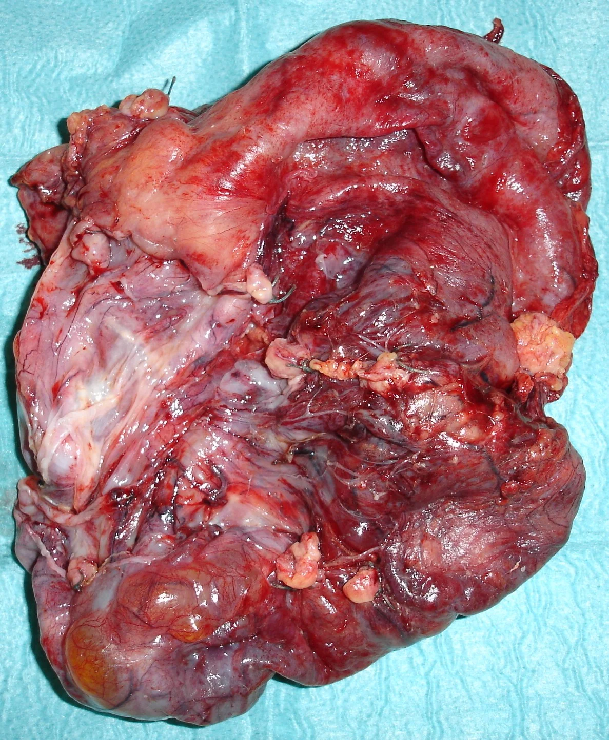 ABDOMINAL SARCOMA