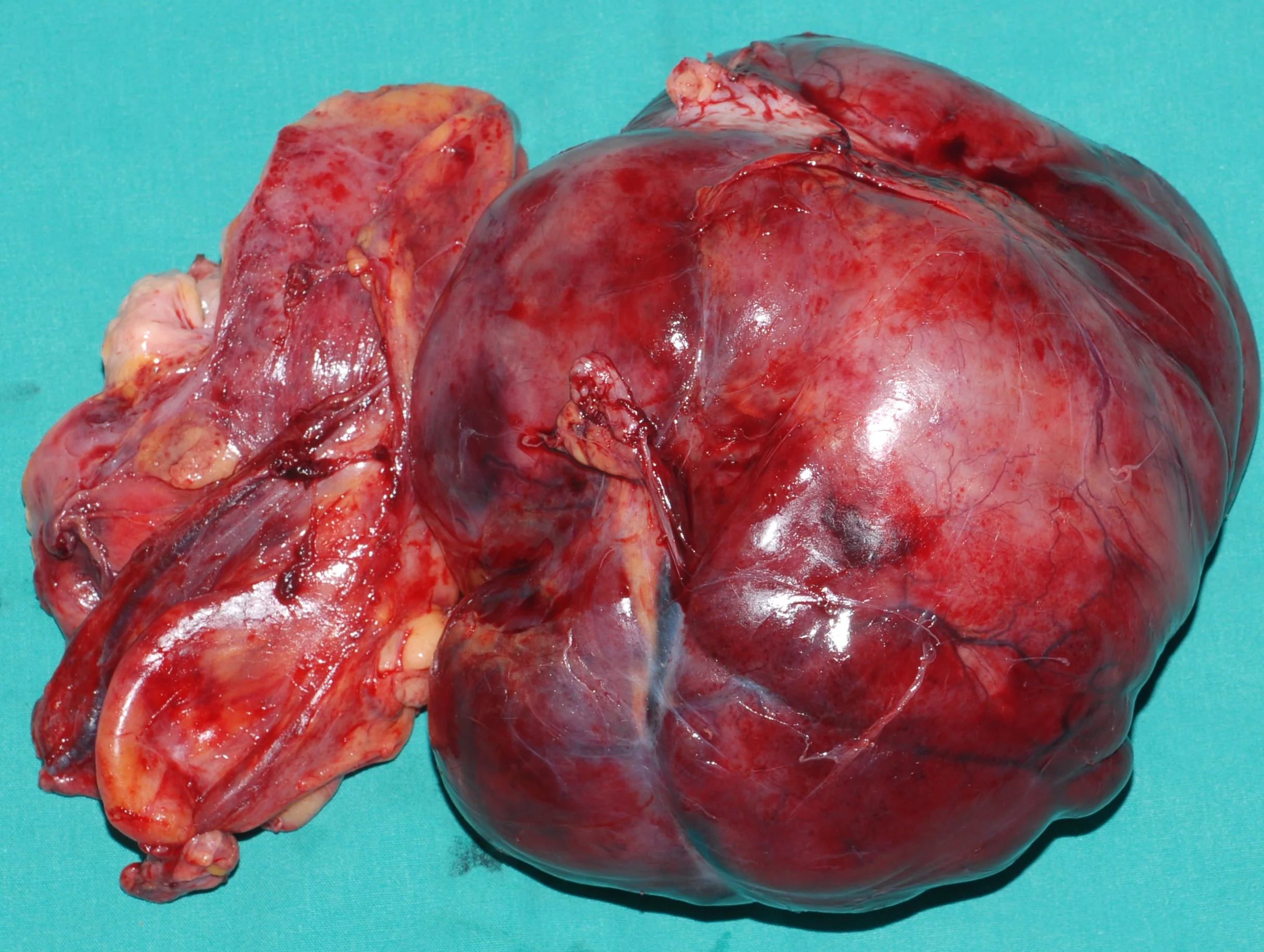 ABDOMINAL SARCOMA