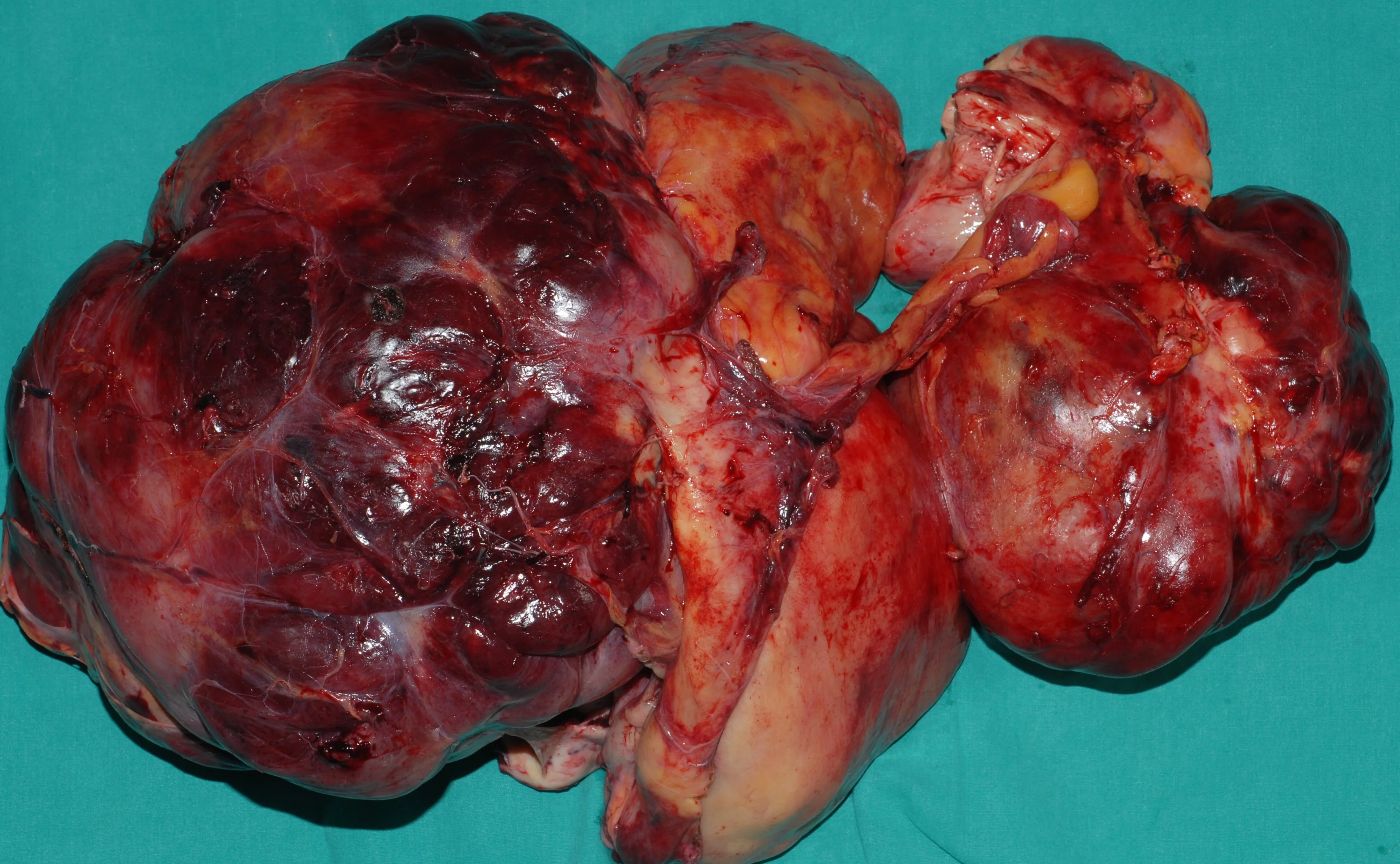 ABDOMINAL SARCOMA