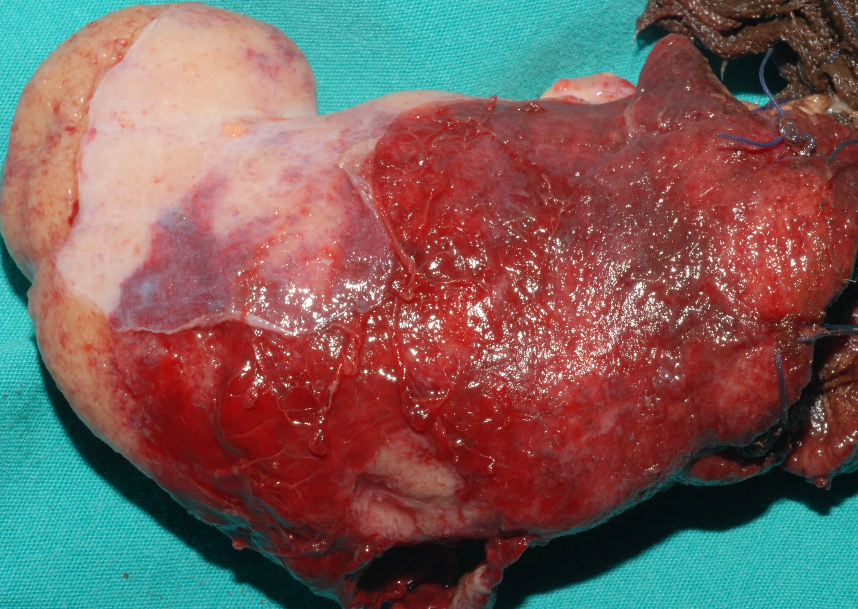 ABDOMINAL SARCOMA