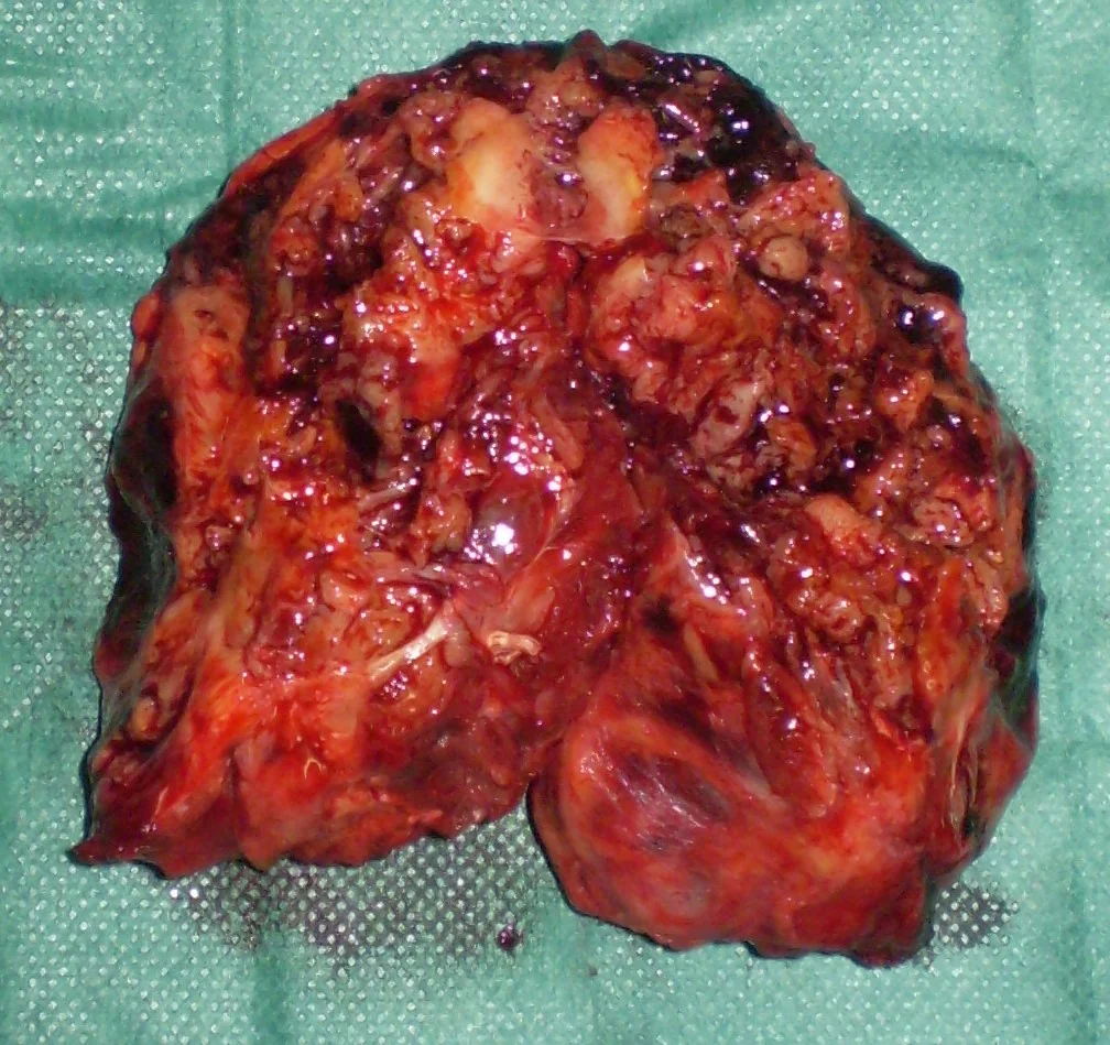 SHOULDER LEIOMYOSARCOMA