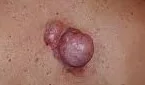SOFT TISSUE SARCOMA