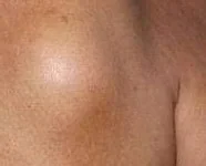 SOFT TISSUE SARCOMA