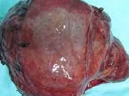 SOFT TISSUE SARCOMA
