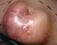 SOFT TISSUE SARCOMA