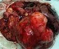 SOFT TISSUE SARCOMA