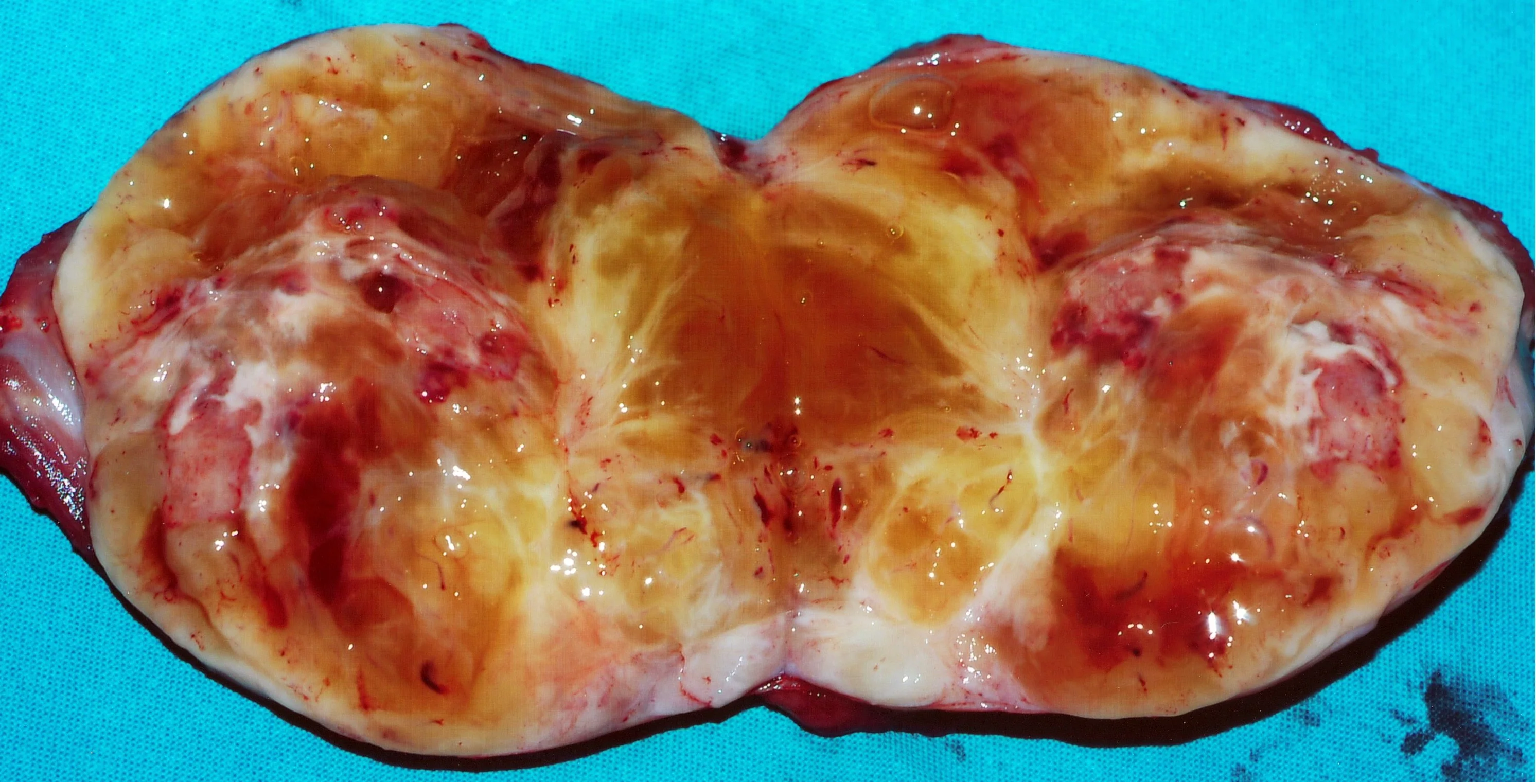 CHEST WALL SARCOMA