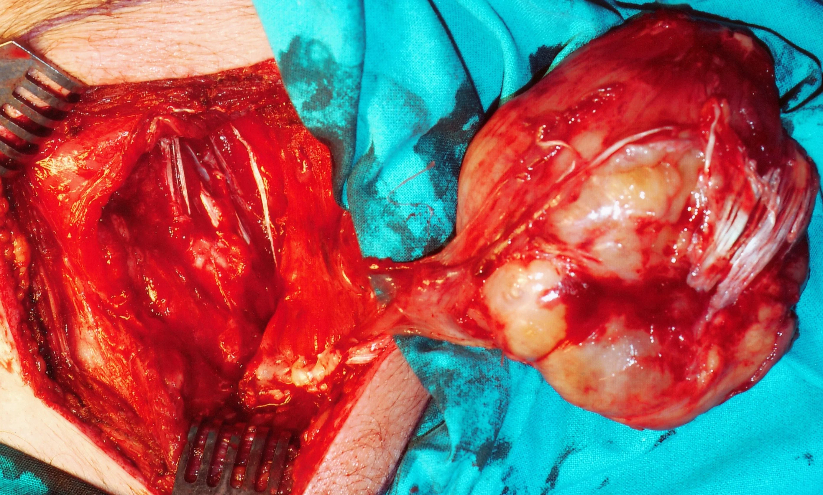 CHEST WALL SARCOMA