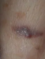 KAPOSI SARCOMA