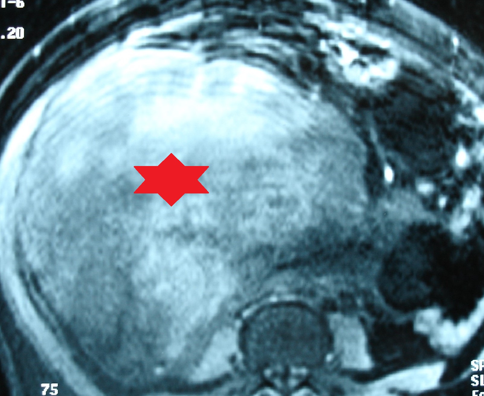 ABDOMINAL LEIOMYOSARCOMA