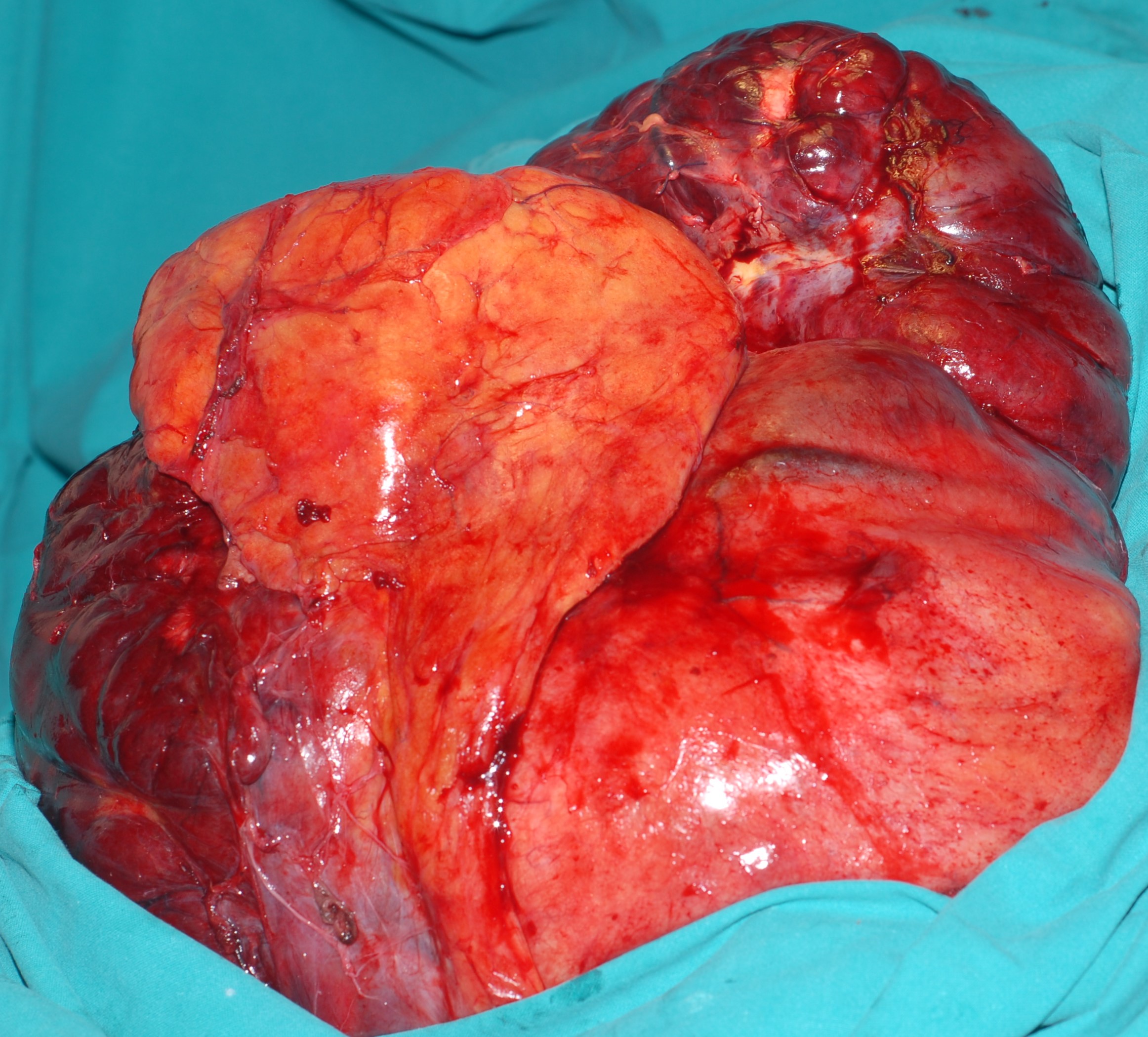 ABDOMINAL LEIOMYOSARCOMA 