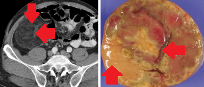 ABDOMINAL LIPOSARCOMA 