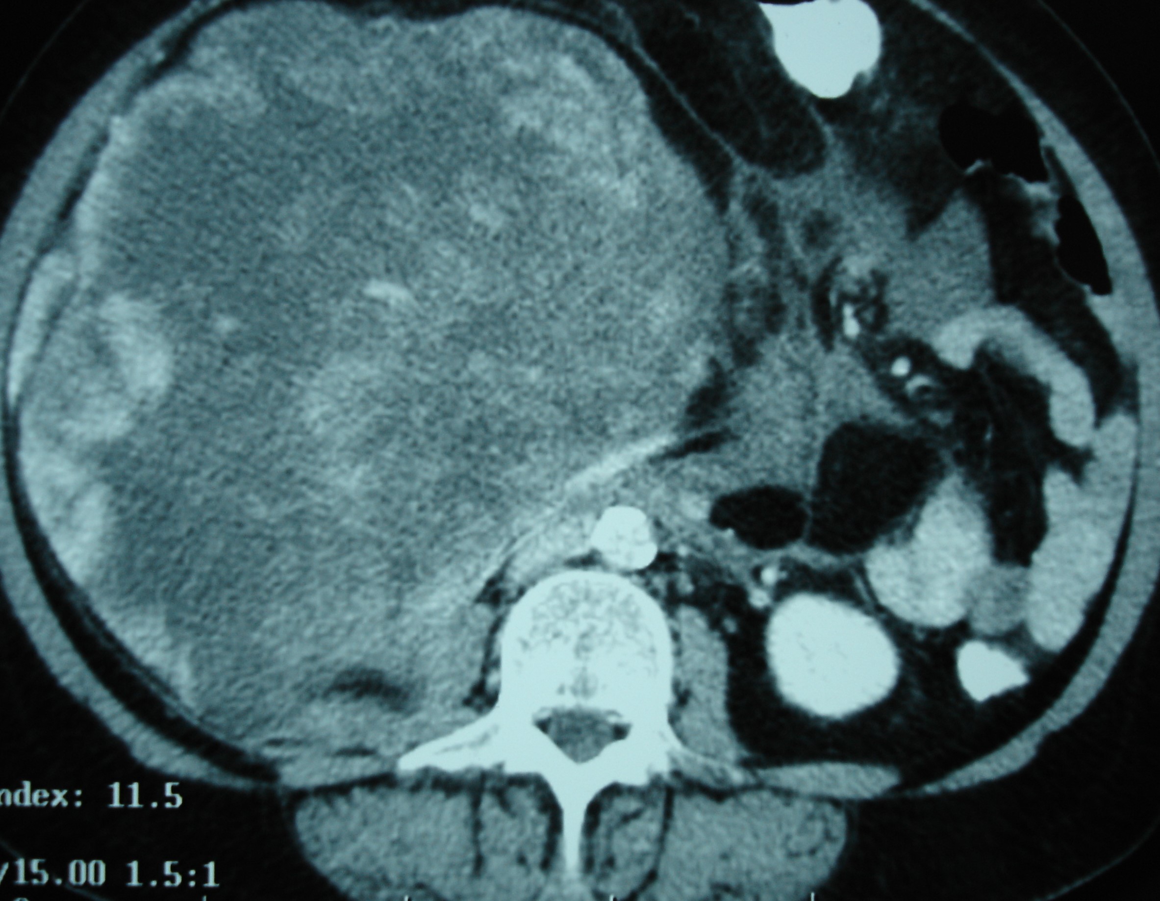 ABDOMINAL SARCOMA