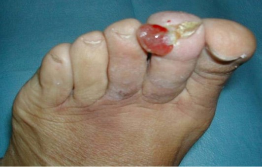 KAPOSI'Σ SARCOMA