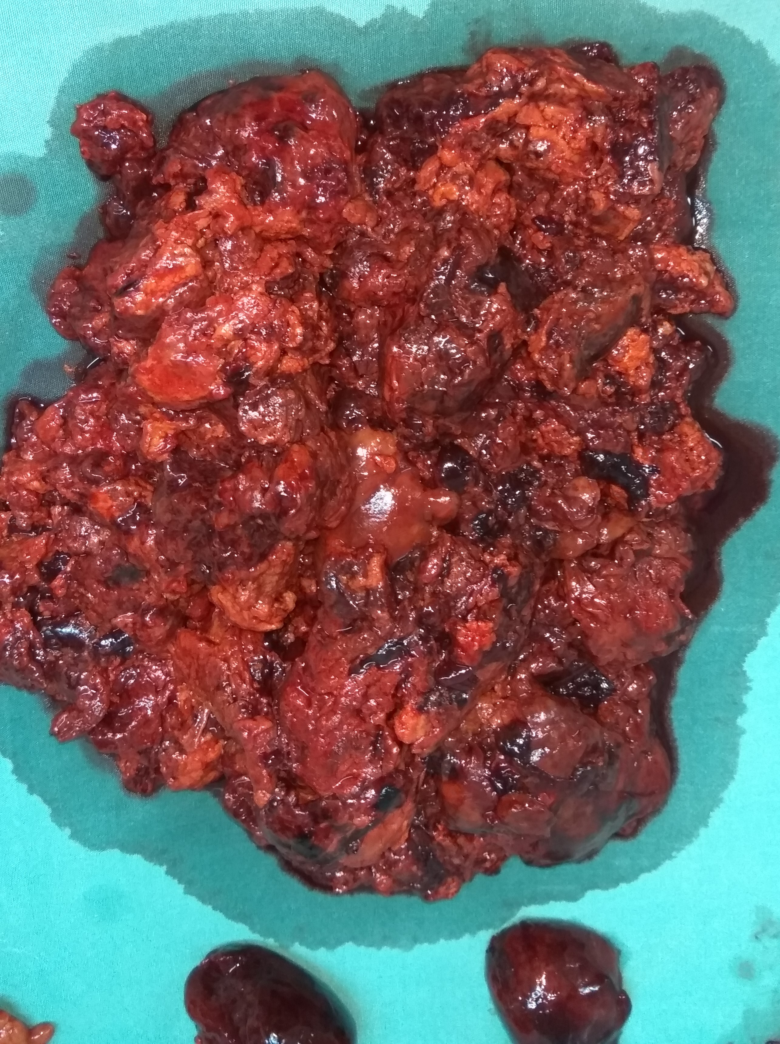 ANGIOSARCOMA