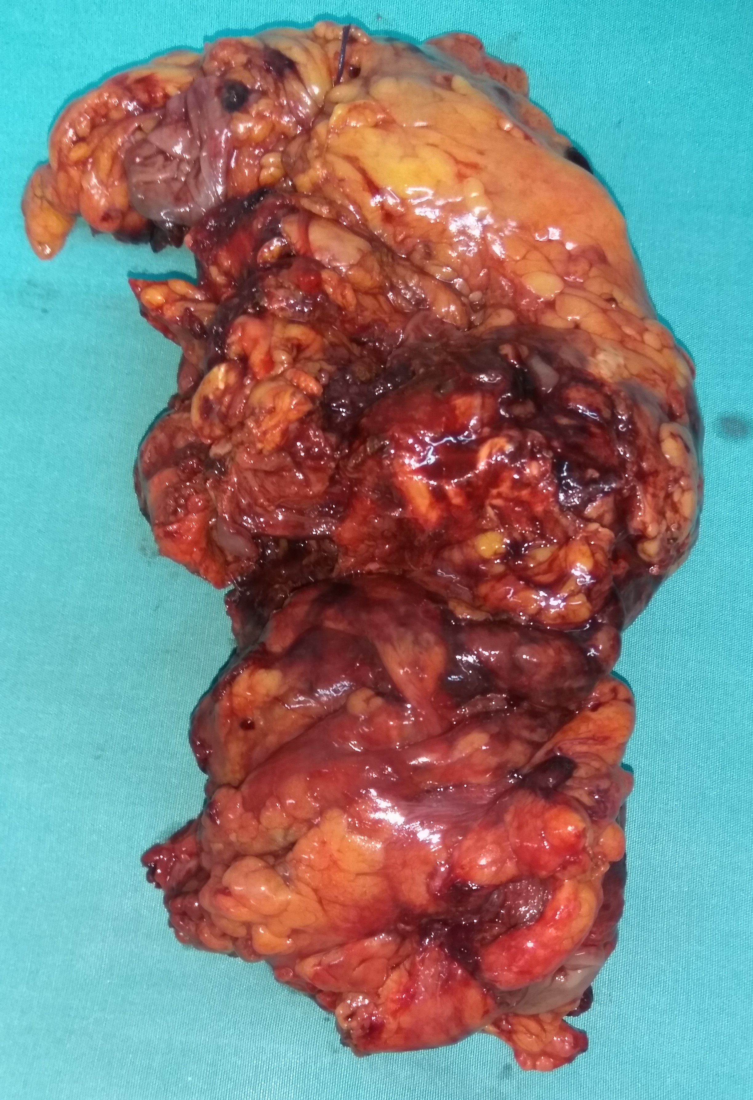 DESCENDING COLON INFILTRATED BY THE ANGIOSARCOMA