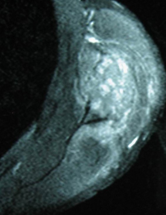 CLEAR CELL SCAPULA SARCOMA