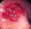 COLONIC SARCOMA KAPOSI