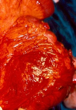 INTRA-ABDOMINAL SARCOMAS