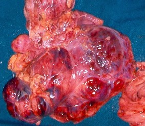 INTRA-ABDOMINAL SARCOMAS