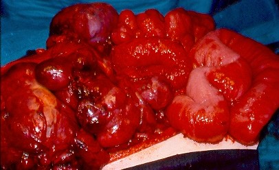INTRA-ABDOMINAL SARCOMAS