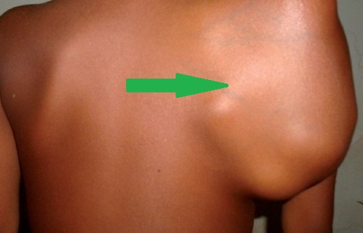 SCAPULAR EWING'S SARCOMA