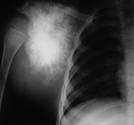 SCAPULAR EWING'S SARCOMA
