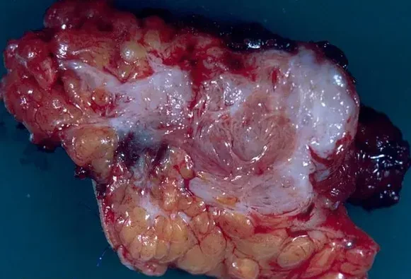 FIBROSARCOMA