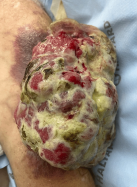 FUNGATING SARCOMA
